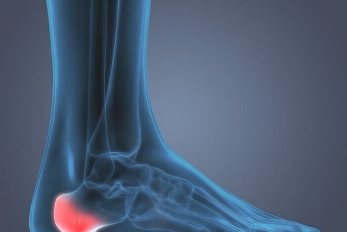 How to Cure Plantar Fasciitis in One Week