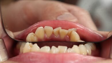 How Long Until a Tooth Infection Kills You